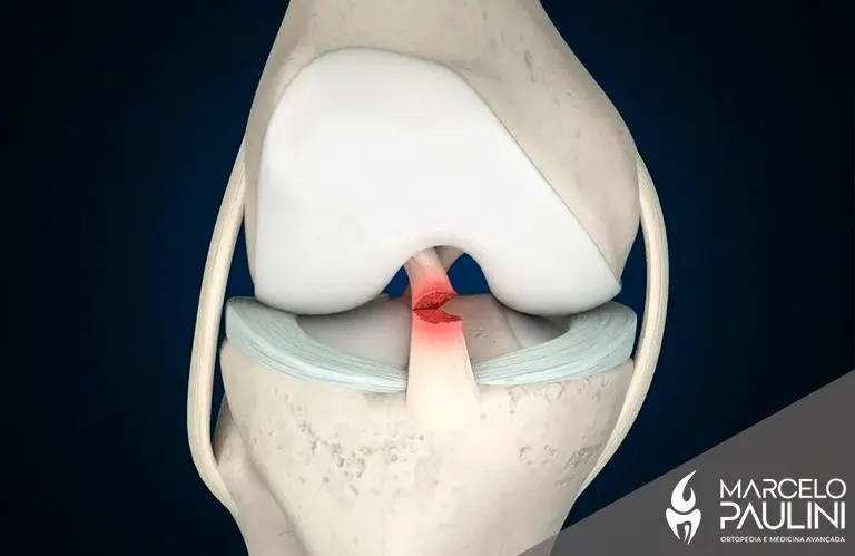Lesão de ligamento cruzado: cirurgia, recuperação e prognóstico