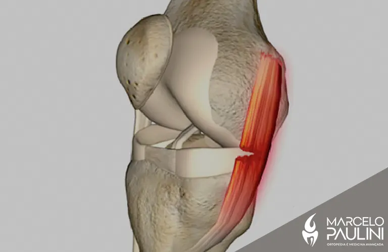 Lesões de ligamento no joelho: tipos, sintomas e tratamentos mais comuns
