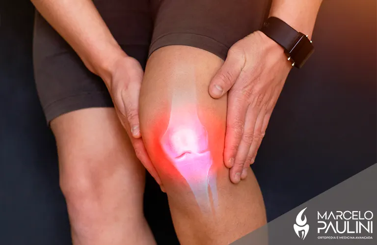 Luxação do Joelho ou Entorse? Entenda as Diferenças e Como Tratar