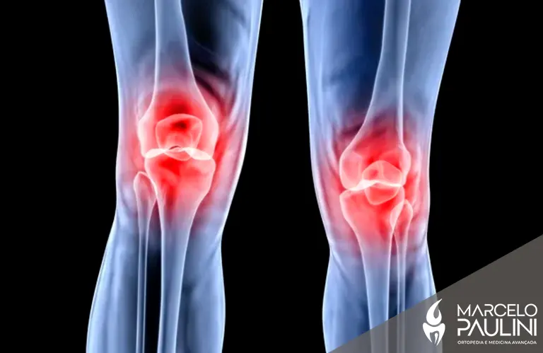 Desgaste na patela: por que seu joelho dói e como cuidar antes que piore