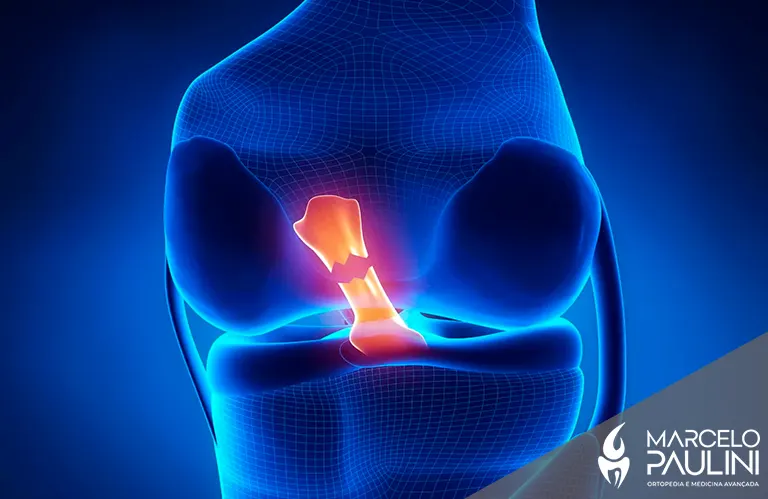 Ligamento cruzado anterior: 7 sinais que você sofreu uma lesão